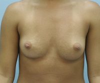 Breast Augmentation