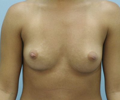 Breast Augmentation