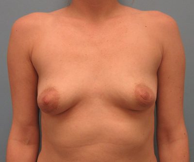 Breast Augmentation