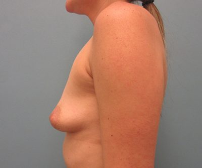 Breast Augmentation