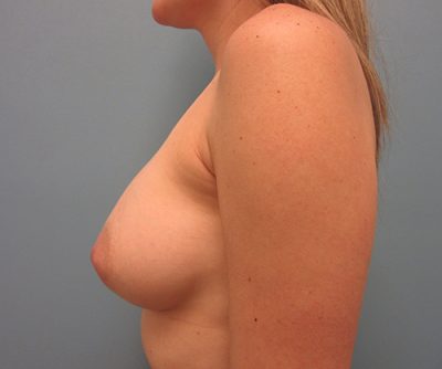 Breast Augmentation