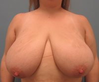 Breast Reduction