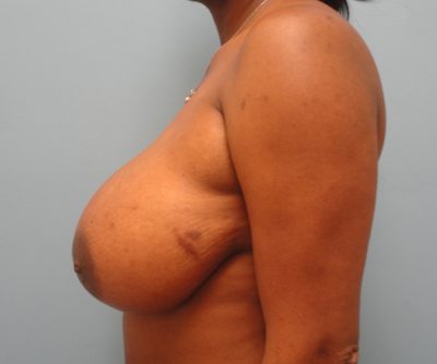 Breast Reduction