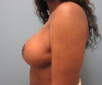 Breast Reduction