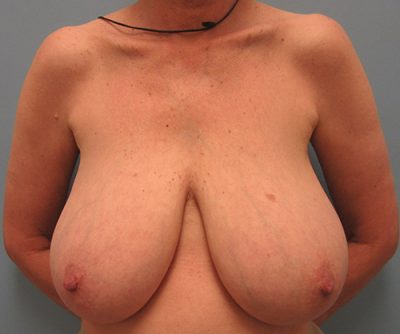 Breast Reduction