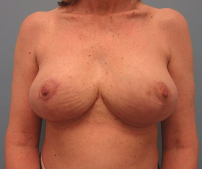 Breast Reduction