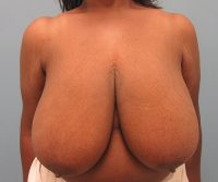 Breast Reduction