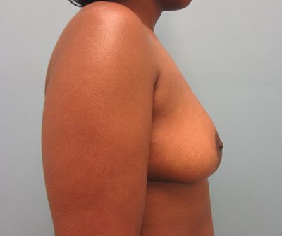 Breast Reduction