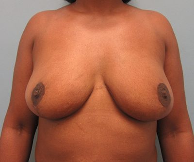 Breast Reduction