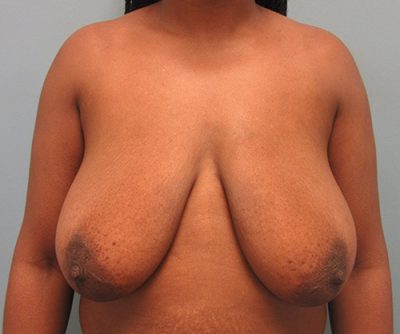 Breast Reduction