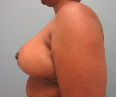 Breast Reduction