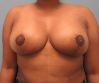 Breast Reduction