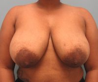 Breast Reduction