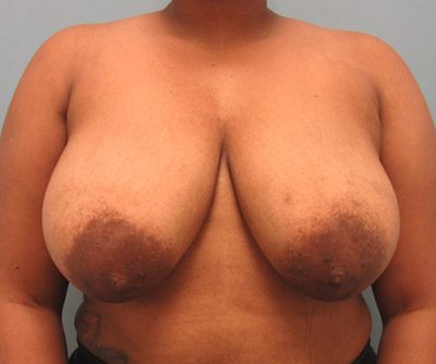 Breast Reduction