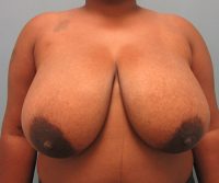 Breast Reduction