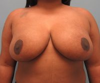 Breast Reduction