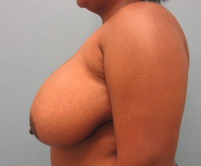 Breast Reduction