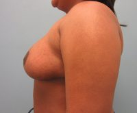 Breast Reduction