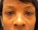 Upper and Lower Blepharoplasty