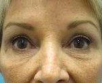 Upper and Lower Blepharoplasty