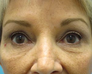 Upper and Lower Blepharoplasty