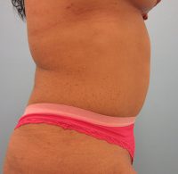 Abdominoplasty