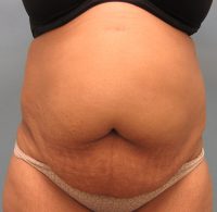 Abdominoplasty