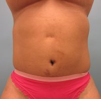 Abdominoplasty