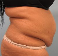 Abdominoplasty