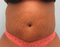 Abdominoplasty