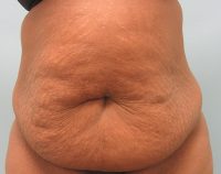 Abdominoplasty