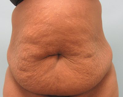 Abdominoplasty