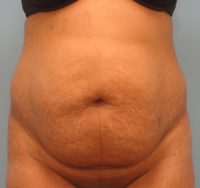 Abdominoplasty