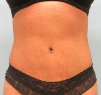 Abdominoplasty