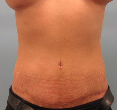 Abdominoplasty