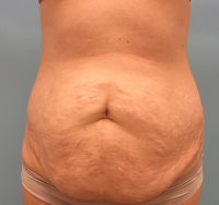 Abdominoplasty