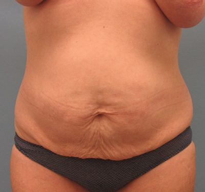 Abdominoplasty