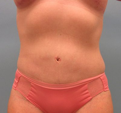 Abdominoplasty