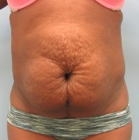 Abdominoplasty