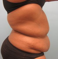 Abdominoplasty