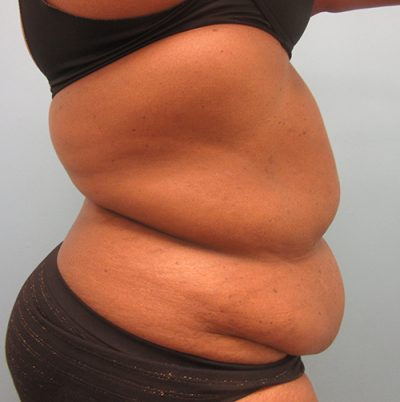 Abdominoplasty