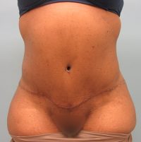 Abdominoplasty