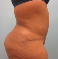 Abdominoplasty