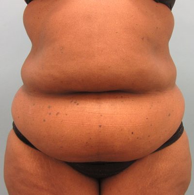 Abdominoplasty