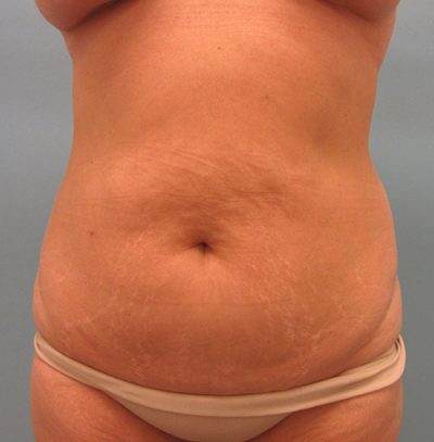 Abdominoplasty