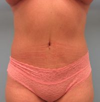 Abdominoplasty