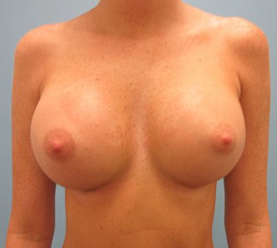 Breast Augmentation