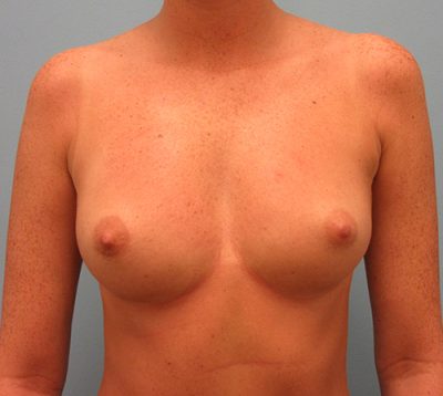 Breast Augmentation