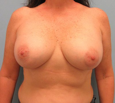 Breast Augmentation