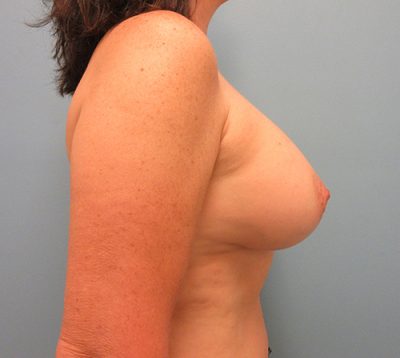 Breast Augmentation